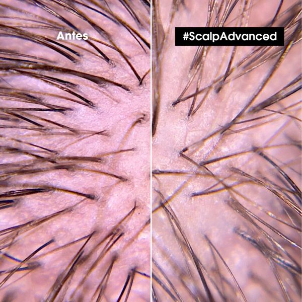 Tratamiento Scalp Advanced Cuero cabelludo Sensible - L'Oréal Professionel 200 ml - Imagen 3
